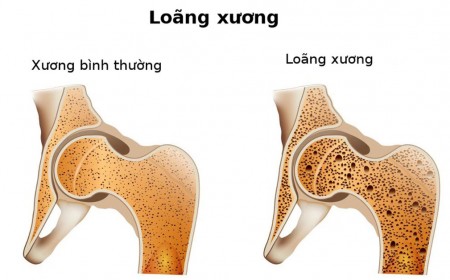 TRIỆU CHỨNG NGUYÊN NHÂN VÀ CÁCH KHẮC PHỤC LOÃNG XƯƠNG Ở TRẺ EM