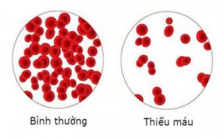 NHẬN BIẾT VÀ CÁCH PHÒNG THIẾU MÁU DINH DƯỠNG