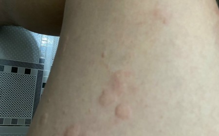 Bệnh Giun Lươn Strongyloides: Nguy Hiểm Nhưng Dễ Bỏ Sót