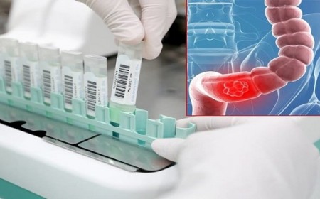 XÉT NGHIỆM TÌM MÁU ẨN TRONG PHÂN CÓ THỂ PHÁT HIỆN ĐƯỢC GÌ?