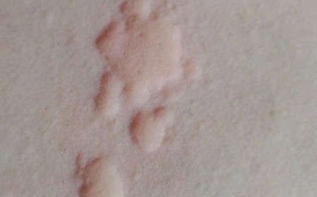 Nổi Ngứa, Mề Đay, Dị Ứng Lâu Ngày Có Phải Bị Nhiễm Sán Chó Toxocara Canis Không?