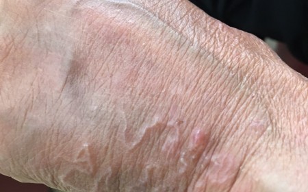 Ấu Trùng Giun Móc Ký Sinh Dưới Da