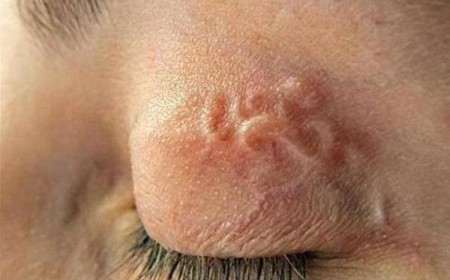 Những Biến Chứng Nguy Hiểm Của Bệnh Sán Chó