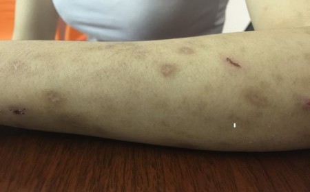 Bệnh Chàm Và Những Yếu Tố Liên Quan Đến Bệnh Giun Sán