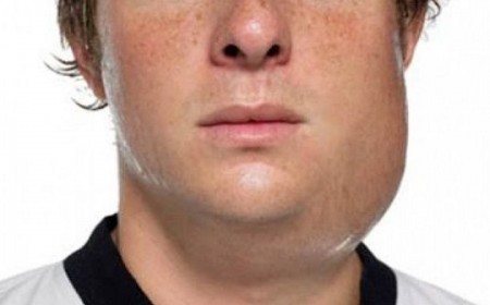 BỆNH QUAI BỊ GÂY NHỀU BIẾN CHỨNG NGUY HIỂM