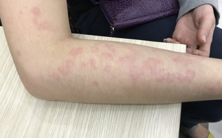 Bệnh sán chó: Những điều cần biết về bệnh sán chó ở Toxocara