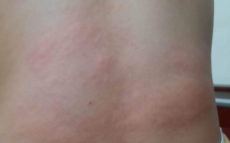 Người Đàn Ông Phát Ban Mẩn Đỏ Khắp Người, Sau Ba Tháng Mới Tìm Ra Nguyên Nhân