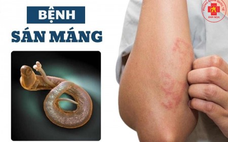 Bệnh Sán Máng Schistosoma: Nguyên Nhân, Lây Nhiễm Và Cách Điều Trị