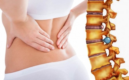 THOÁT VỊ ĐĨA ĐỆM KHI NÀO CẦN PHẪU THUẬT