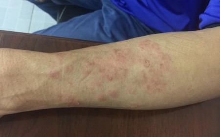 Bị Ngứa Da Do Giun Sán Dấu Hiệu Nhận Biết Và Thời Gian Điều Trị