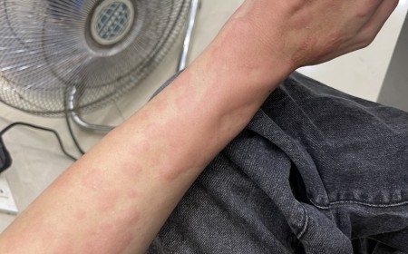 Biểu Hiện Giống Bệnh Sán Chó Toxocara, Nếu Không Cần Xét Nghiệm Thì Có Dùng Thuốc Chữa Luôn Được Khô