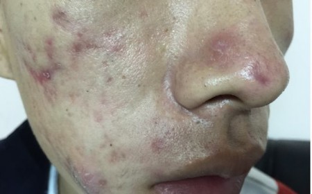 Cách Trị Dị Ứng Da Lâu Ngày Hiệu Quả Tại Phòng Khám Ký Sinh Trùng