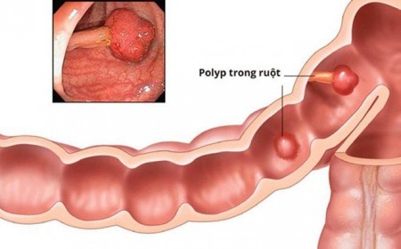 Chảy Máu Đường Tiêu Hóa