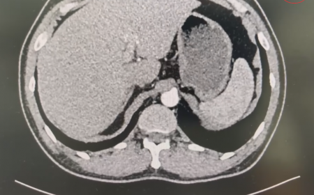 Tổng Quan Về Bệnh Sán Lá Gan: Nguyên Nhân, Con Đường Lây Truyền Và Cách Điều Trị Hiệu Quả