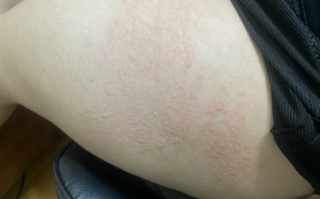 Con Mạt Bụi Nhà Là Gì? Nguyên Nhân Gây Dị Ứng, Cách Phòng Ngừa Và Xử Trí Hiệu Quả Con Mạt Bụi Nhà