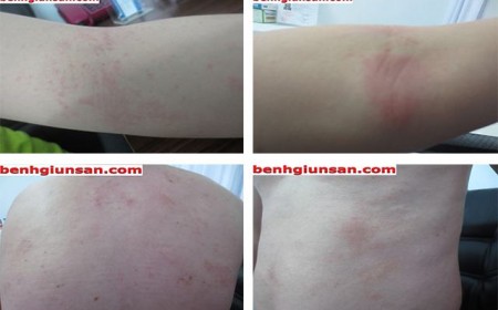 Dấu hiệu nhận biết bệnh giun đũa chó và cách chữa giun đũa chó hiệu quả