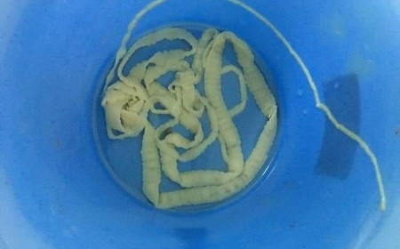 ​Dấu Hiệu Nhận Biết Bệnh Sán Dây Và Cách Chữa Trị