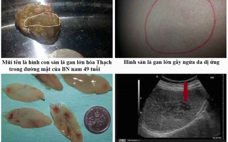 DẤU HIỆU NHẬN BIẾT BỆNH SÁN LÁ GAN LỚN