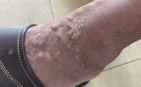 Nổi Cục Dị Ứng Mẩn Ngứa Kéo Dài Có Phải Do Sán Chó Mèo?