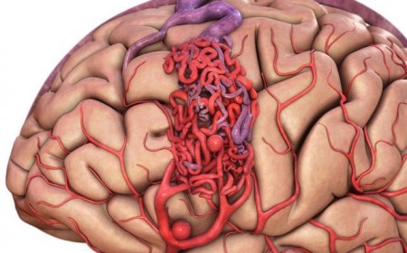 NGUY HIỂM TÍNH MẠNG NẾU BỊ DỊ DẠNG MẠCH MÁU NÃO