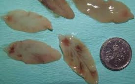 Điều trị bệnh sán lá gan ở đâu?