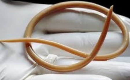 Nguyên Nhân Triệu Chứng Và Cách Phòng Bệnh Giun Đũa