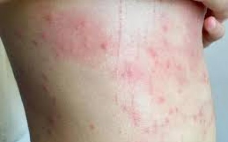 Nguyên Nhân Gây Bệnh Sán Chó Ở Người