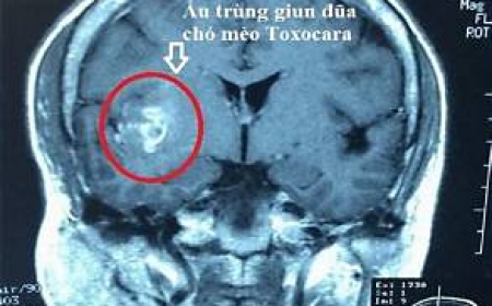 Dương Tính Với Sán Chó Toxocara Có Phải Đã Lên Não?