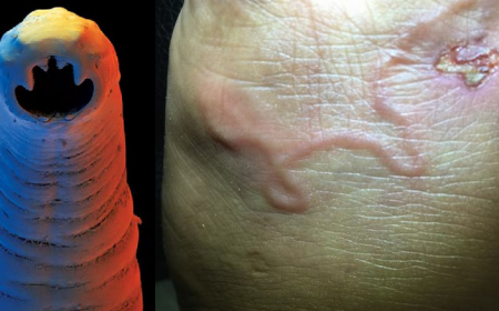 Giun Móc Và Giun Mỏ: Hiểu Đúng Để Phòng Bệnh Hiệu Quả