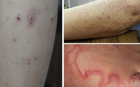 Giun Sán Gây Ngứa Da: Coi Chừng Ấu Trùng Lạc Chỗ