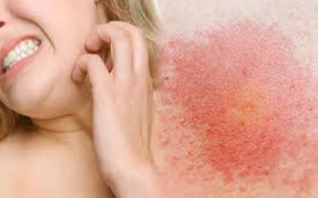 Dấu hiệu ngứa da do nhiễm ký sinh trùng