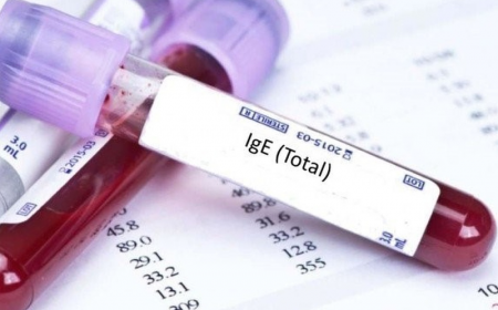 Kết Quả Xét Nghiệm Máu Có Chỉ Số IgE Tăng Cao: Nguyên Nhân Và Cách Điều Trị Hiệu Quả