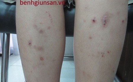 Mẩn Ngứa Da Nổi Mề Đay Có Phải Do Nhiễm Giun Sán Không?