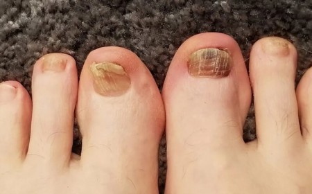 5 DẤU HIỆU Ở MÓNG CHÂN CẦN ĐI KHÁM GẤP