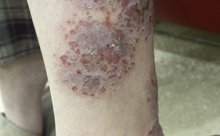 Ngứa Da Lâu Ngày Ở Trẻ: Cẩn Thận Ấu Trùng Giun Sán Toxocara