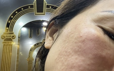 Ngứa Da Mặt Kéo Dài Có Phải Do Demodex?