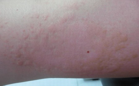 Ngứa Da Nổi Mề Đay Có Phải Do Nhiễm Giun Sán Không?