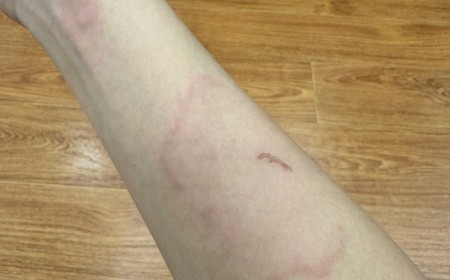 Ngứa Da Nổi Vòng Loang Rộng Cảnh Báo Nhiễm Giun Sán Toxocara