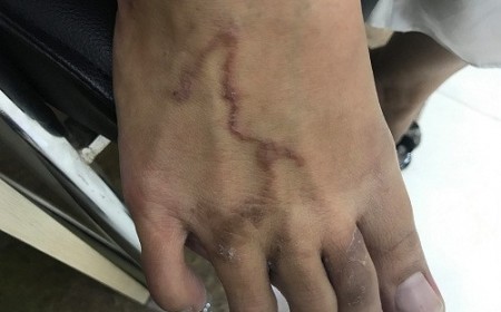 Bệnh Giun Đũa Chó Có Thể Trị Khỏi Hoàn Toàn Được Không