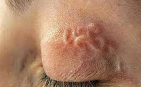 Nhiều Người Ngứa Hậu Môn Hoảng Hốt Trước Hậu Quả Của Bệnh Giun Sán