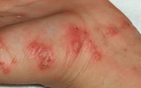 Triệu Chứng Nhiễm Giun Đũa Chó Dễ Nhầm Với Bệnh Da Liễu