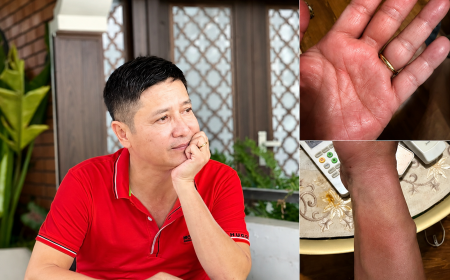 NSƯT Chí Trung Phát Hiện Nhiễm Sán Chó Toxocara Sau Nhiều Tháng Ngứa Kéo Dài