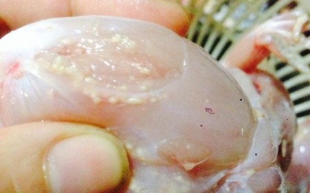 Ngứa Mu Bàn Chân Do Nhiễm Giun Sán