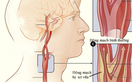 TẠI SAO CHÓNG MẶT HOẶC CHOÁNG VÁNG KHI ĐỨNG LÊN?