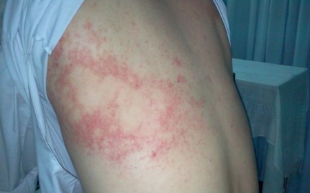 Tại sao khám bệnh viện da liễu nhiều năm không hết ngứa?