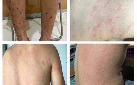 Thuốc Điều Trị Bệnh Sán Chó, Bệnh Sán Chó Bao Lâu Xét Nghiệm Lại?
