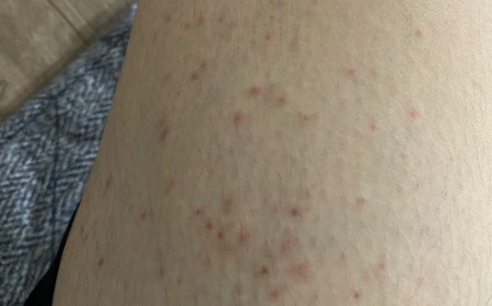 TÔI KHÔNG NGỜ ĐẾN MÌNH CŨNG BỊ NHIỄM SÁN CHÓ