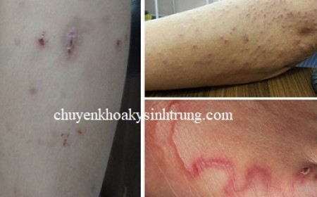TỔNG QUAN VỀ NHIỄM GIUN LƯƠN