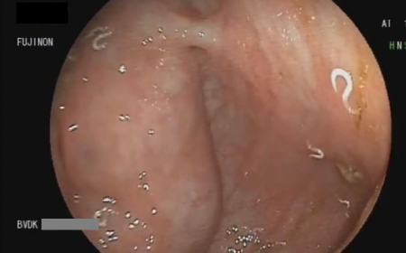 Trẻ Ngứa Hậu Môn Ban Đêm Có Phải Giun Kim?