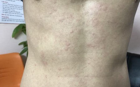 TRIỆU CHỨNG GIUN SÁN CHÓ MÈO